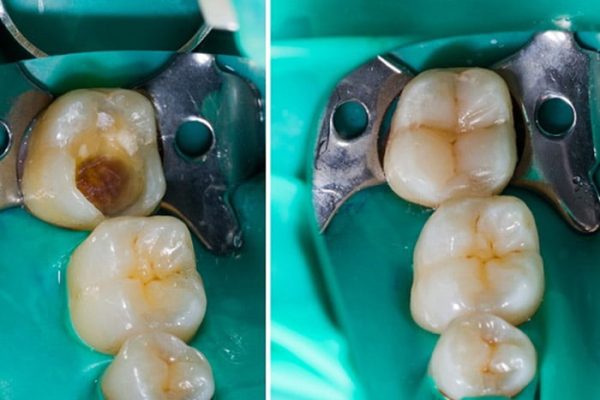 Composite-Filling1