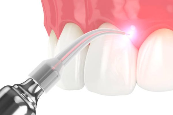 3d render of dental diode laser used to treat gums. The concept of using laser therapy in the treatment of gums