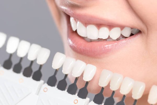 Beautiful smile and white teeth of a young woman. Matching the shades of the implants or the process of teeth whitening.