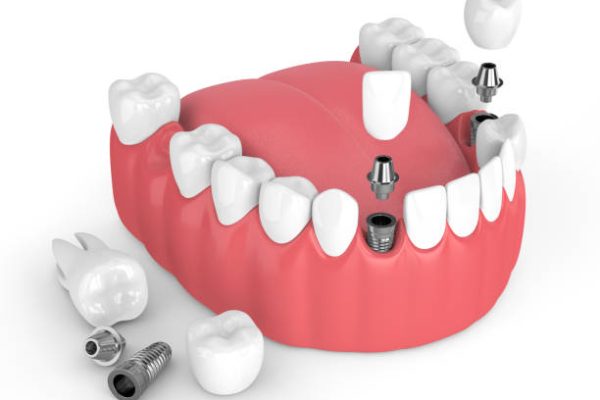3d render of jaw with dental implants over white background